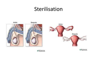 Sterilisation
 