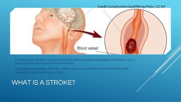 stroke rehabilitation ppt presentation Physical therapy & stroke rehabilitation powerpoint presentation.