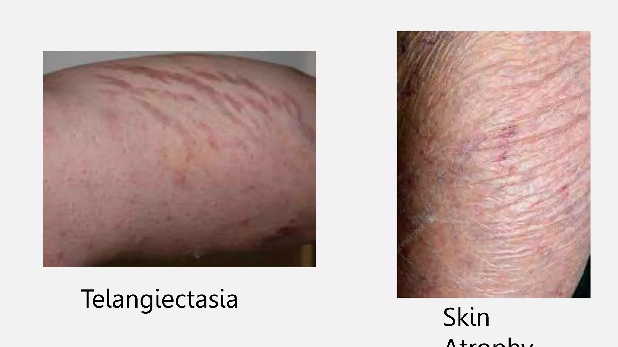 Telangiectasia
Skin
 