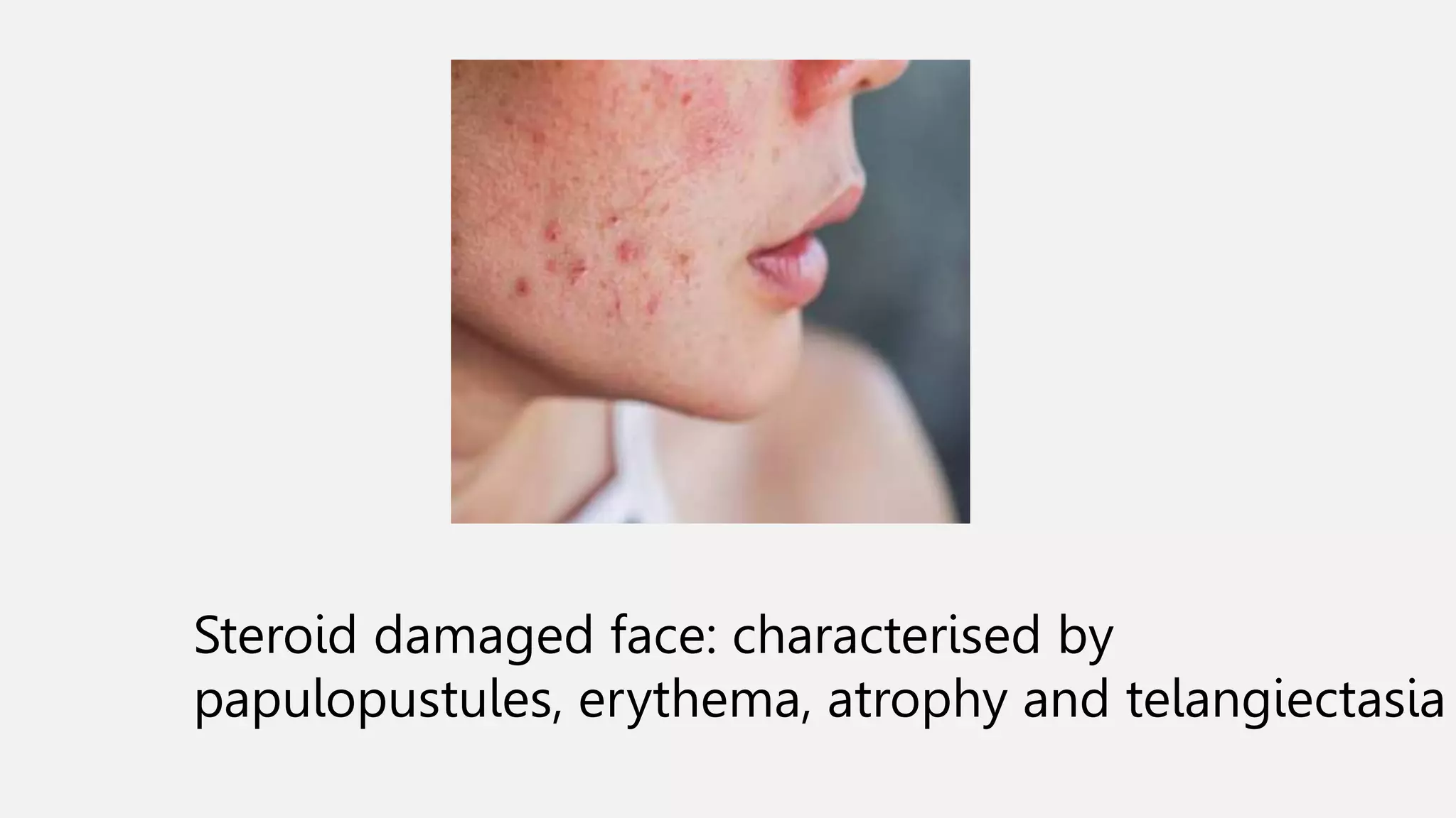 Steroid damaged face: characterised by
papulopustules, erythema, atrophy and telangiectasia
 