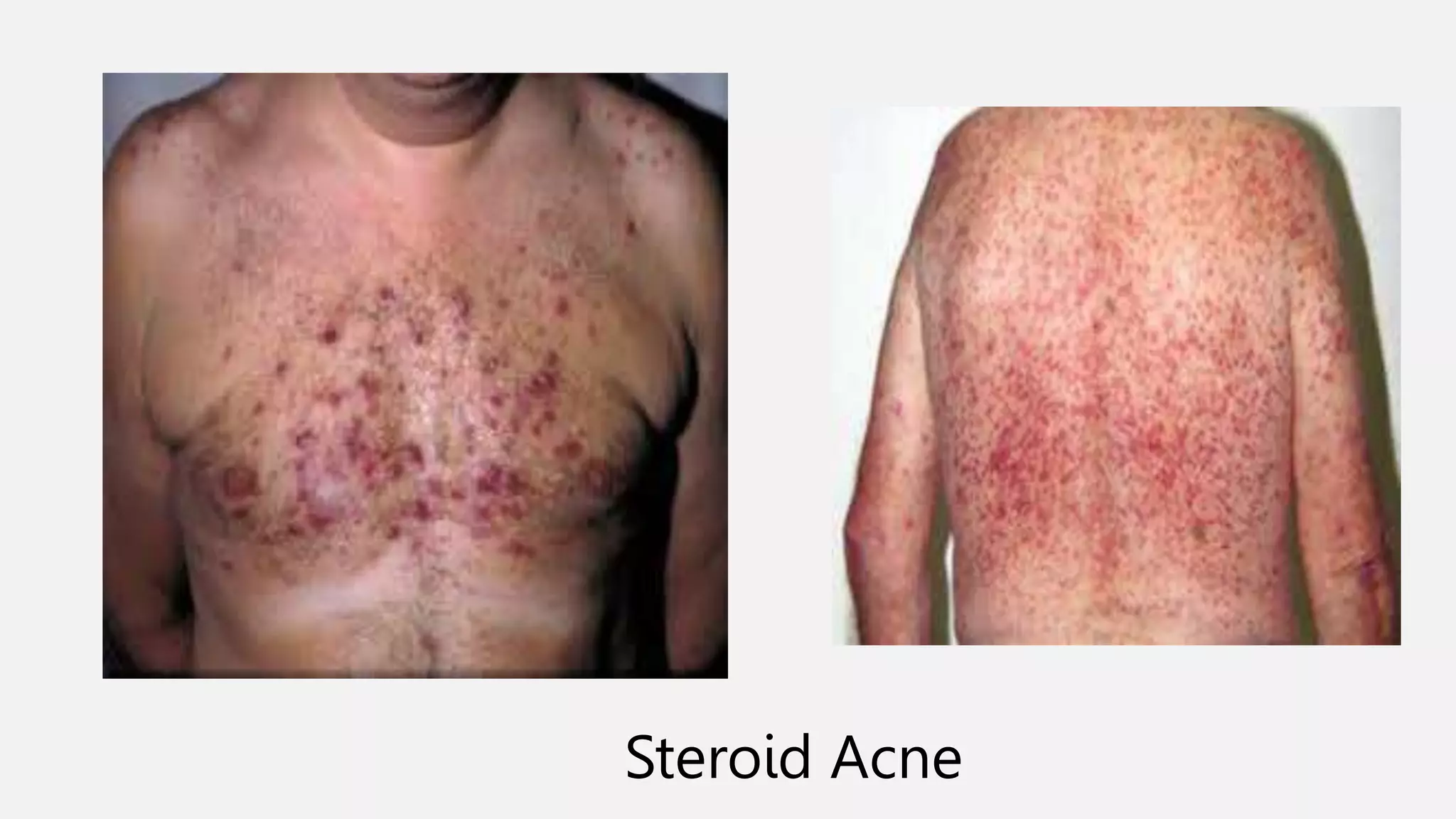 Steroid Acne
 
