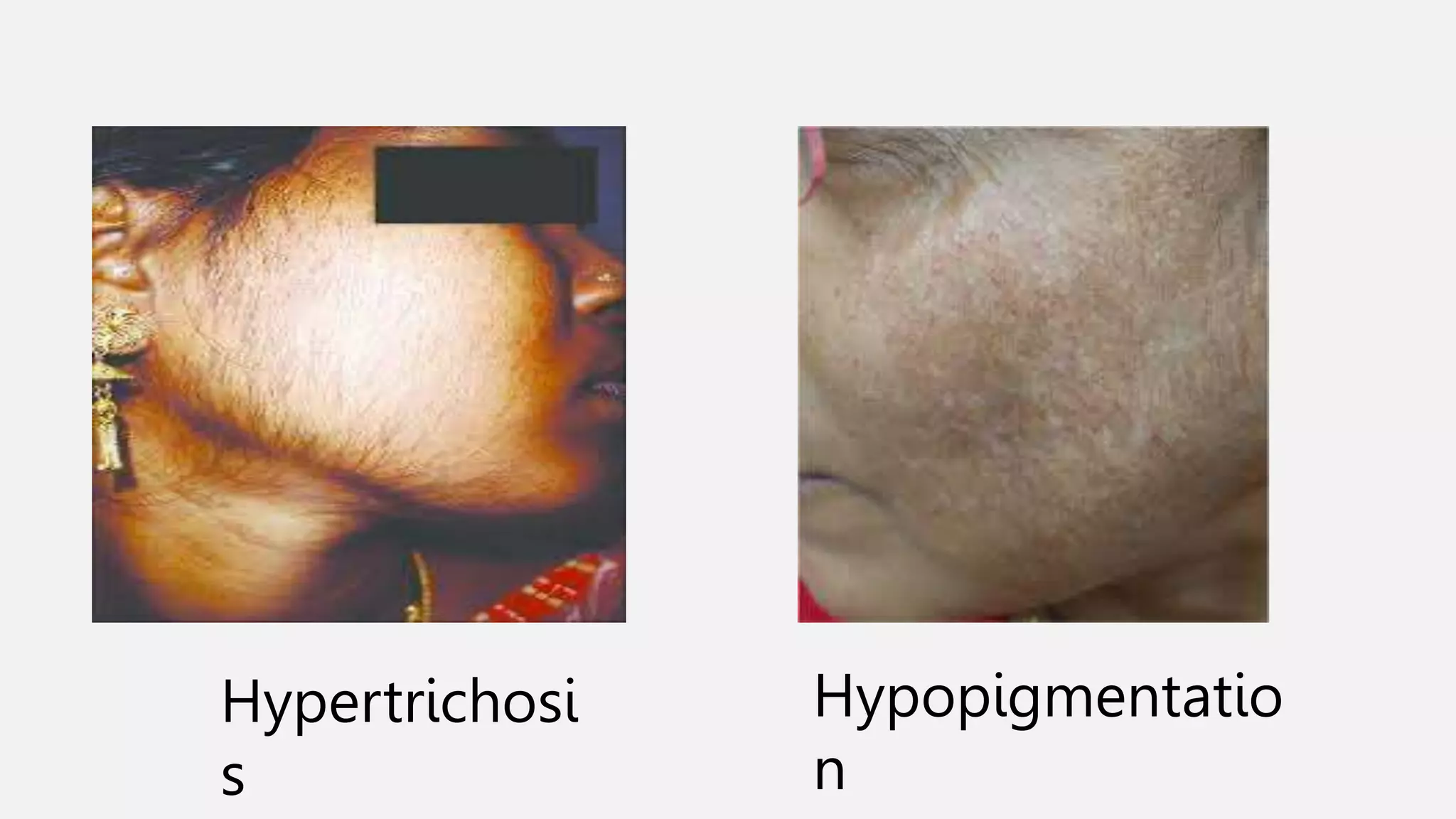Hypertrichosi
s
Hypopigmentatio
n
 