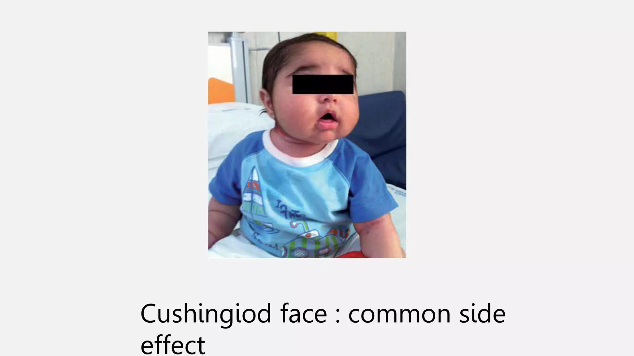 Cushingiod face : common side
effect
 