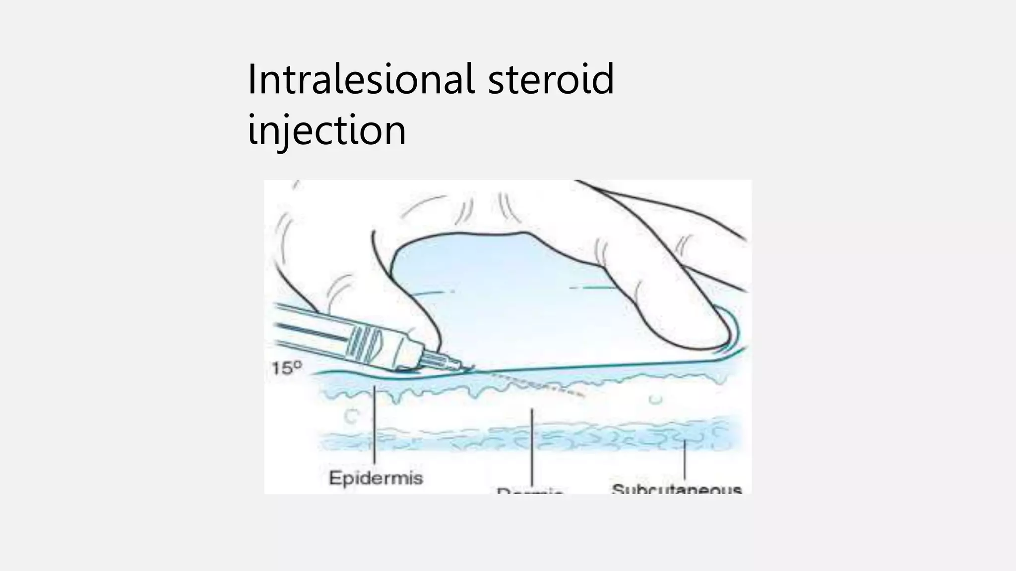 Intralesional steroid
injection
 