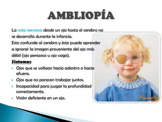 La ruta nerviosa desde un ojo hasta el cerebro no
se desarrolla durante la infancia.
Esto confunde al cerebro y éste puede aprender
a ignorar la imagen proveniente del ojo más
débil (ojo perezoso u ojo vago).
Síntomas:
 Ojos que se voltean hacia adentro o hacia
   afuera.
 Ojos que no parecen trabajar juntos.

 Incapacidad para juzgar la profundidad
   correctamente.
 Visión deficiente en un ojo.
 