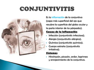 Es la inflamación de la conjuntiva
(capa más superficial del ojo que
recubre la superficie del globo ocular y
la parte interior de los párpados).
Causas de la inflamación:
 Infección (conjuntivitis infecciosa).

 Alergia (conjuntivitis alérgica).

 Química (conjuntivitis química).

 Cuerpo extraño (conjuntivitis
   irritativa).
Síntomas:
 Hinchazón, picazón, ardor, lagrimeo
   y enrojecimiento de la conjuntiva.
 