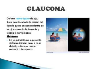Daña al nervio óptico del ojo.
Suele ocurrir cuando la presión del
líquido que se encuentra dentro de
los ojos aumenta lentamente y
lesiona el nervio óptico.
Síntomas:
 En un principio, no se presenta
   síntomas iniciales pero, si no se
   detecta a tiempo, puede
   conducir a la ceguera.
 