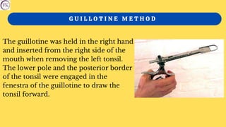 The guillotine was held in the right hand
and inserted from the right side of the
mouth when removing the left tonsil.
The lower pole and the posterior border
of the tonsil were engaged in the
fenestra of the guillotine to draw the
tonsil forward.
G U I L L O T I N E M E T H O D
 
