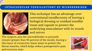 I N T R A C A P S U L A R T O N S I L L E C T O M Y B Y M I C R O D E B R I D E R
This technique has an advantage over
conventional tonsillectomy of leaving a
biological dressing or residual tonsillar
tissue and capsule to protect the
underlying musculature with its vessels
and nerves
The surgeon uses the microdebrider to precisely
remove greater than 95 percent of the tonsils, leaving a
thin layer of connective tissue intact to protect the
throat muscles, which helps reduce postoperative pain
and recovery time.
 