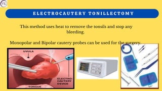 E L E C T R O C A U T E R Y T O N I L L E C T O M Y
This method uses heat to remove the tonsils and stop any
bleeding.
Monopolar and Bipolar cautery probes can be used for the surgery.
 