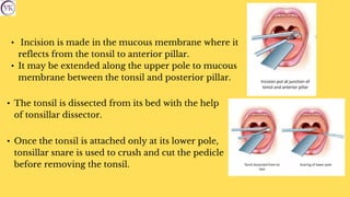 • Incision is made in the mucous membrane where it
reflects from the tonsil to anterior pillar.
• It may be extended along the upper pole to mucous
membrane between the tonsil and posterior pillar.
• The tonsil is dissected from its bed with the help
of tonsillar dissector.
• Once the tonsil is attached only at its lower pole,
tonsillar snare is used to crush and cut the pedicle
before removing the tonsil.
 