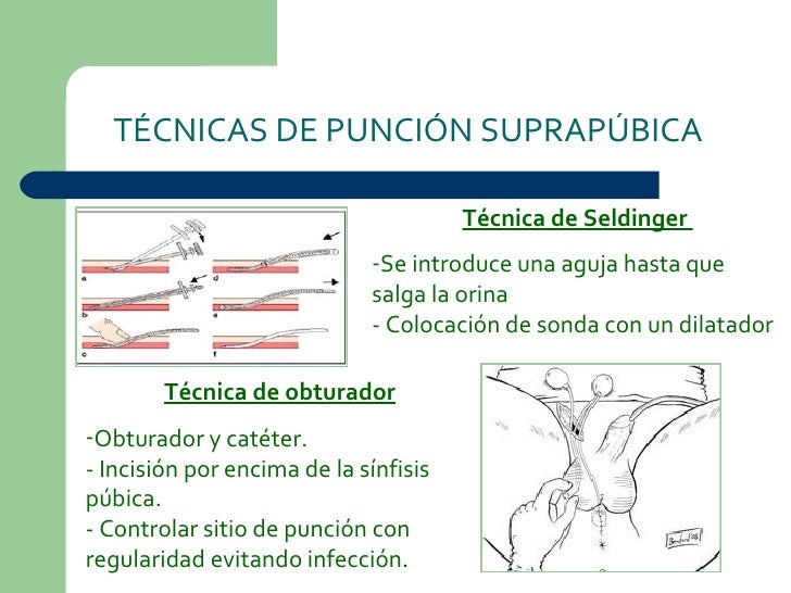 La orina y sus métodos de extracción