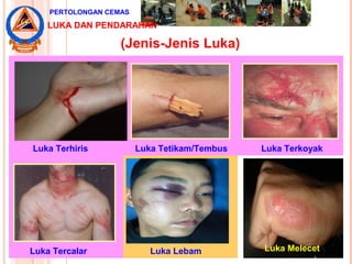 (Jenis-Jenis Luka)
Luka Terhiris Luka Tetikam/Tembus Luka Terkoyak
Luka Tercalar Luka Lebam
PERTOLONGAN CEMAS
Luka Melecet
LUKA DAN PENDARAHAN
 