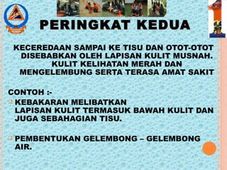 PERINGKAT KEDUAPERINGKAT KEDUA
KECEREDAAN SAMPAI KE TISU DAN OTOT-OTOT
DISEBABKAN OLEH LAPISAN KULIT MUSNAH.
KULIT KELIHATAN MERAH DAN
MENGELEMBUNG SERTA TERASA AMAT SAKIT
CONTOH :-
 KEBAKARAN MELIBATKAN
LAPISAN KULIT TERMASUK BAWAH KULIT DAN
JUGA SEBAHAGIAN TISU.
 PEMBENTUKAN GELEMBONG – GELEMBONG
AIR.
 