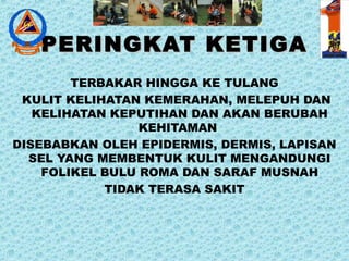 PERINGKAT KETIGAPERINGKAT KETIGA
TERBAKAR HINGGA KE TULANG
KULIT KELIHATAN KEMERAHAN, MELEPUH DAN
KELIHATAN KEPUTIHAN DAN AKAN BERUBAH
KEHITAMAN
DISEBABKAN OLEH EPIDERMIS, DERMIS, LAPISAN
SEL YANG MEMBENTUK KULIT MENGANDUNGI
FOLIKEL BULU ROMA DAN SARAF MUSNAH
TIDAK TERASA SAKIT
 