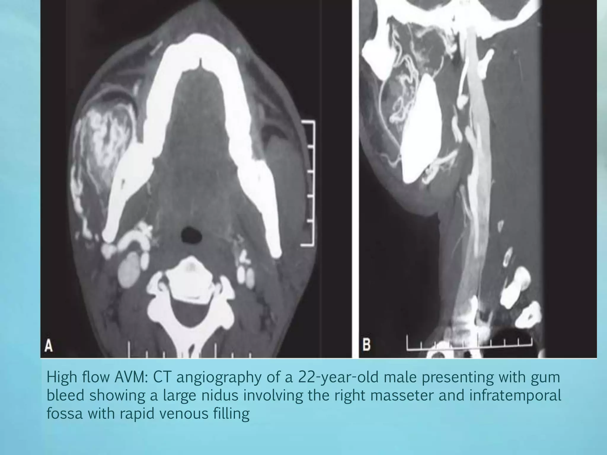 imaging of soft tissue tumours | PPTX