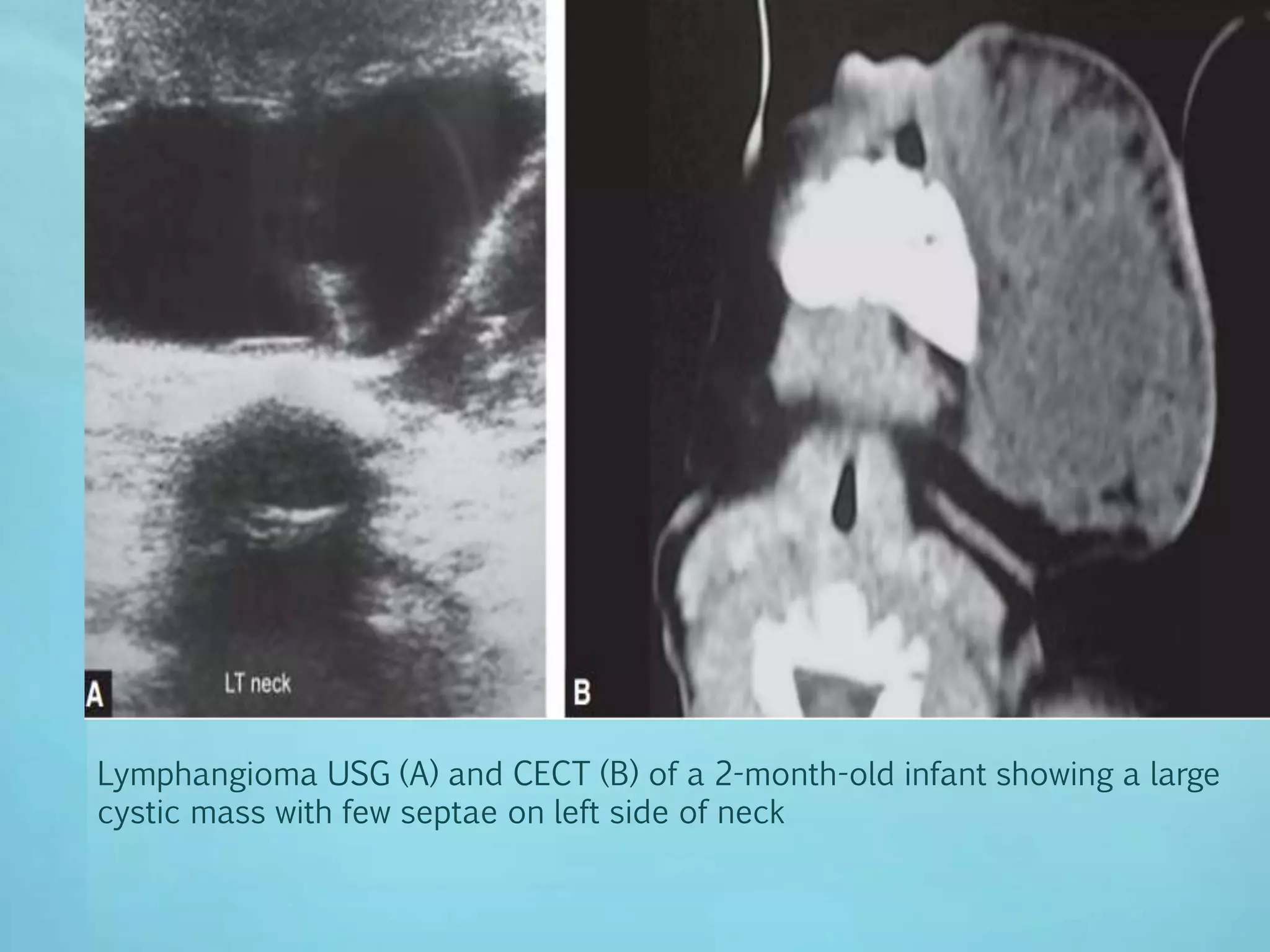 imaging of soft tissue tumours | PPTX