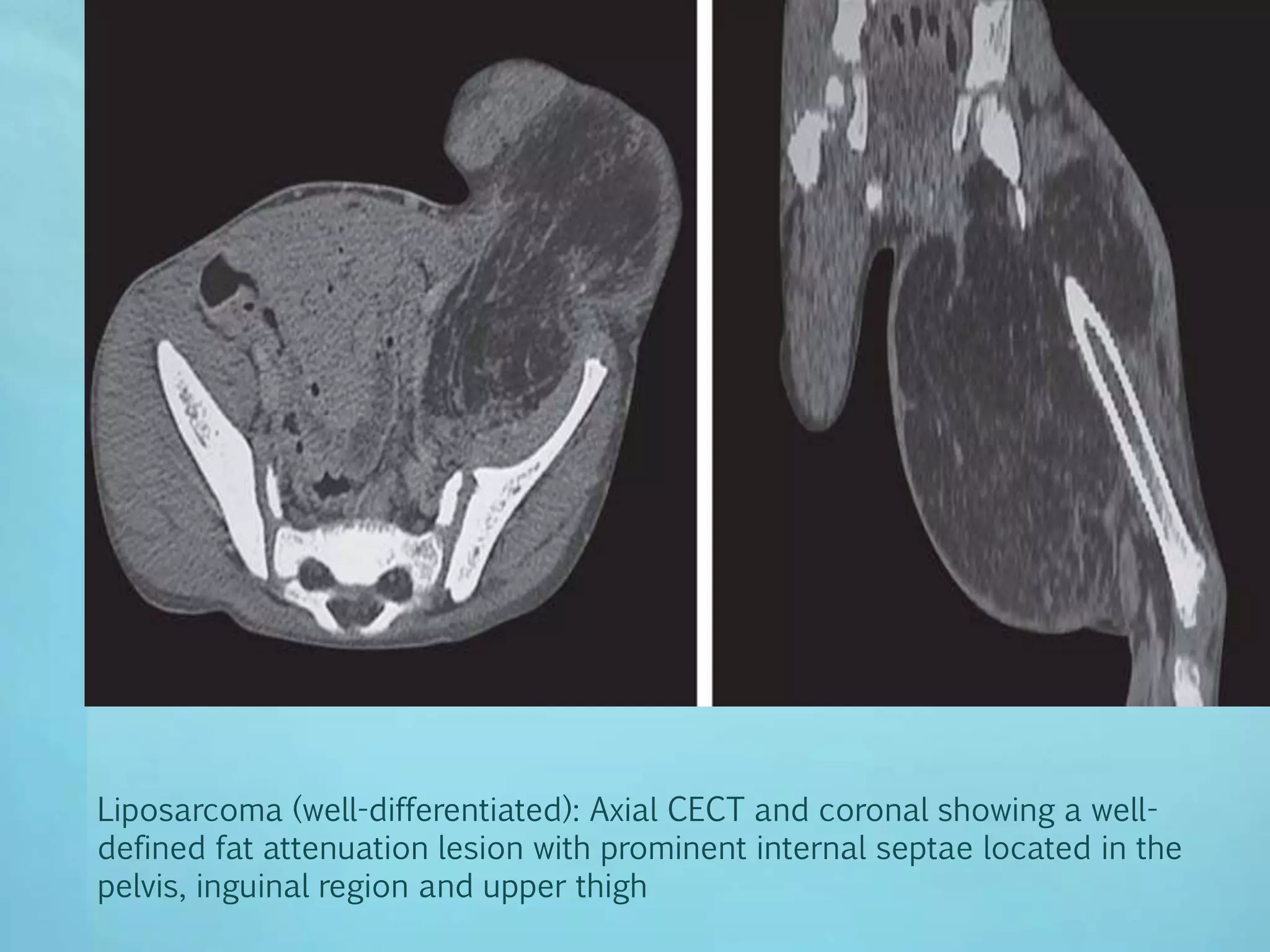 imaging of soft tissue tumours | PPTX