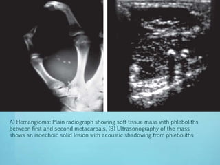 imaging of soft tissue tumours | PPTX