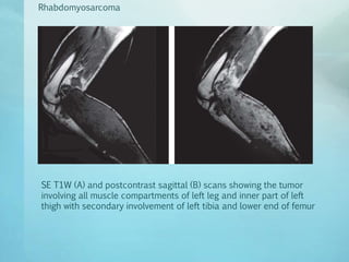 imaging of soft tissue tumours | PPTX