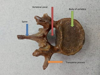 Body of vertebra
Spine
Transverse process
Vertebral canal