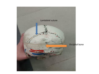 Occipital bone
Lambdoid suture