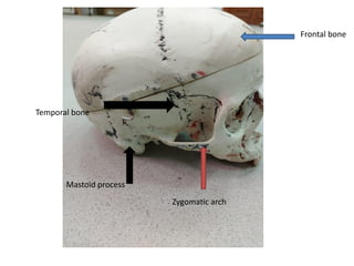 Mastoid process
Zygomatic arch
Temporal bone
Frontal bone
