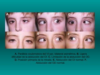 A . Parálisis oculomotora del VI par, bilateral asimétrica . B.  Ligera dificultad de la abducción del OI.  C.  Limitación...
