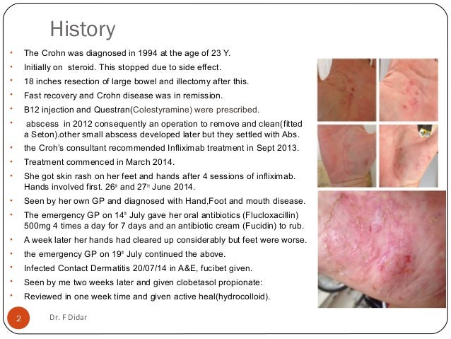 palmoplantar pustolar Psoriasis induced in a patient