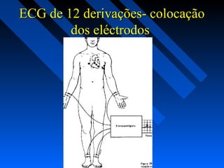 ECG de 12 derivações- colocaçãoECG de 12 derivações- colocação
dos eléctrodosdos eléctrodos
 