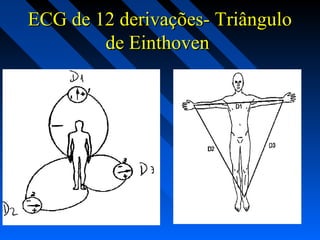 ECG de 12 derivações- TriânguloECG de 12 derivações- Triângulo
de Einthovende Einthoven
 