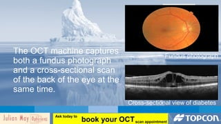 Cross-sectional view of diabetes 
The OCT machine captures 
both a fundus photograph 
and a cross-sectional scan 
of the back of the eye at the 
same time. 
Fundus photograph 
book your OCT Ask today to 
scan appointment 
 