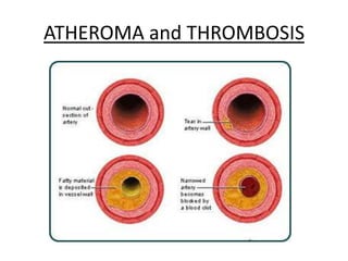 ATHEROMA and THROMBOSIS