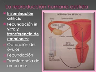 Inseminación artificial Fecundación in vitro y transferencia de embriones: Obtención de óvulos Fecundación Transferencia de embriones 