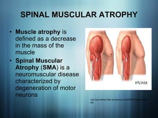 SPINAL MUSCULAR ATROPHY Muscle atrophy  is defined as a decrease in the mass of the muscle Spinal Muscular Atrophy  ( SMA ) is a neuromuscular disease characterized by degeneration of motor neurons http://journalmex.files.wordpress.com/2009/03/sarcopenia.jpg 