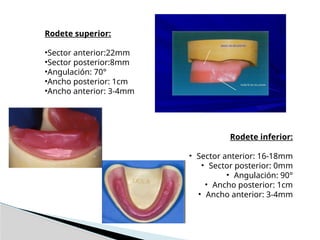 Prótesis Totales - rodetes de mordida sup e inf | PPTX