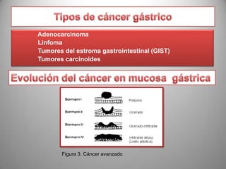 Adenocarcinoma
Linfoma
Tumores del estroma gastrointestinal (GIST)
Tumores carcinoides

Figura 3. Cáncer avanzado

 