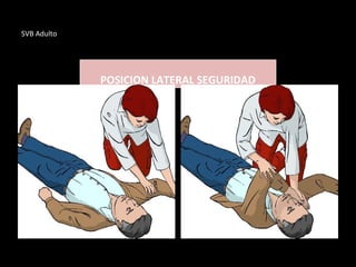 SVB Adulto
POSICION LATERAL SEGURIDAD
 