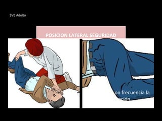 SVB Adulto
POSICION LATERAL SEGURIDAD
Comprobar con frecuencia la
respiración
 