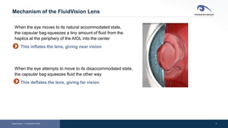 4
Mechanism of the FluidVision Lens
When the eye moves to its natural accommodated state,
the capsular bag squeezes a tiny amount of fluid from the
haptics at the periphery of the AIOL into the center
This inflates the lens, giving near vision
When the eye attempts to move to its disaccommodated state,
the capsular bag squeezes fluid the other way
This deflates the lens, giving far vision
PowerVision │ FluidVision® AIOL
 
