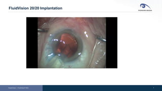 7
FluidVision 20/20 Implantation
PowerVision │ FluidVision® AIOL
 