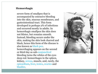 Hemorrhagic severe form of smallpox that is accompanied by extensive bleeding into the skin, mucous membranes, and gastrointestinal tract. This form developed in perhaps 2% of infections and occurred mostly in adults. In hemorrhagic smallpox the skin does not blister, but remains smooth. Instead, bleeding occurs under the skin, making the skin look charred and black, hence this form of the disease is also known as  black pox . hemorrhaging appears on the second or third day as sub- conjunctival  bleeding turns the whites of the eyes deep red. hemorrhages in the spleen, kidney,  serosa , muscle, and, rarely, the  epicardium ,  liver ,  testes ,  ovaries  and  bladder . 
