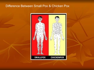 Difference Between Small Pox & Chicken Pox
 
