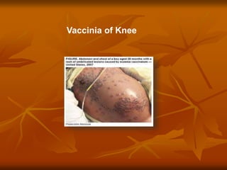 Vaccinia of Knee
 