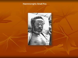 Haemmorrghic Small Pox
 