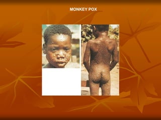 MONKEY POX
 