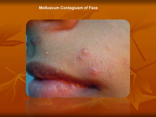 Molluscum Contagiusm of Face
 
