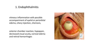 vitreous inflammation with possible
accompaniment of eyelid or periorbital
edema, ciliary injection, chemosis,
anterior chamber reaction, hypopyon,
decreased visual acuity, corneal edema
and retinal hemorrhages
1. Endophthalmitis
 