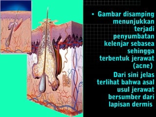 • Gambar disamping
menunjukkan
terjadi
penyumbatan
kelenjar sebasea
sehingga
terbentuk jerawat
(acne)
Dari sini jelas
terlihat bahwa asal
usul jerawat
bersumber dari
lapisan dermis
 