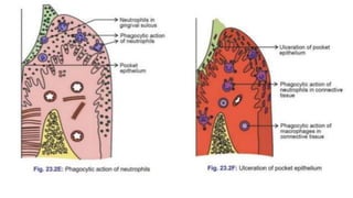Periodontal pocket | PPTX